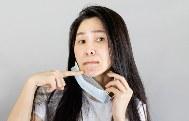 acne mask woman