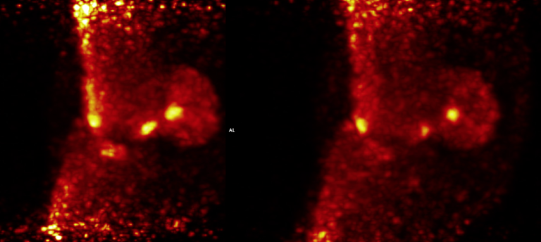 PET scan lateral MIP 6 weeks apart