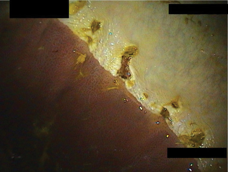 Grade 4 ulcer