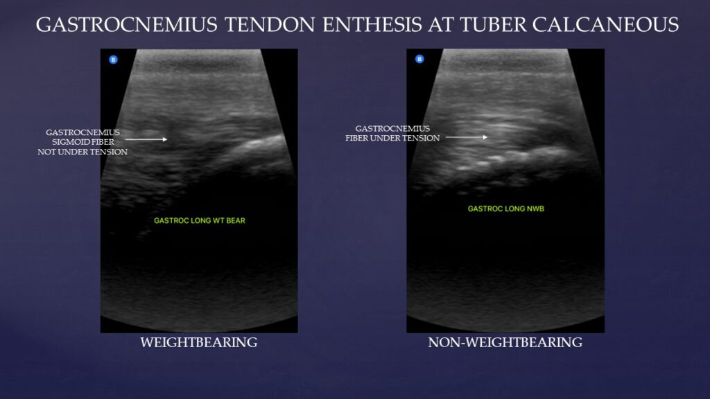 Butterfly ultrasound Gastrocnemius tendon