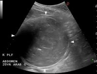 Transverse Ultrasound image of a distended small intestine in a horse suffering from chronic colic