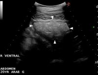 Transverse ultrasound image of a normal small intestine after surgery to address chronic colic in a horse
