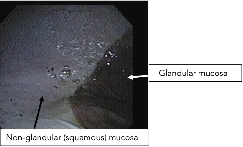 gastroscopy image