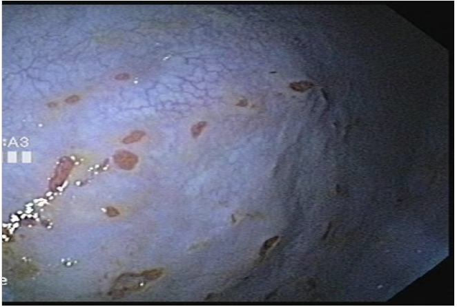 gastroscopy image of horse with grade 3 gastric ulcers