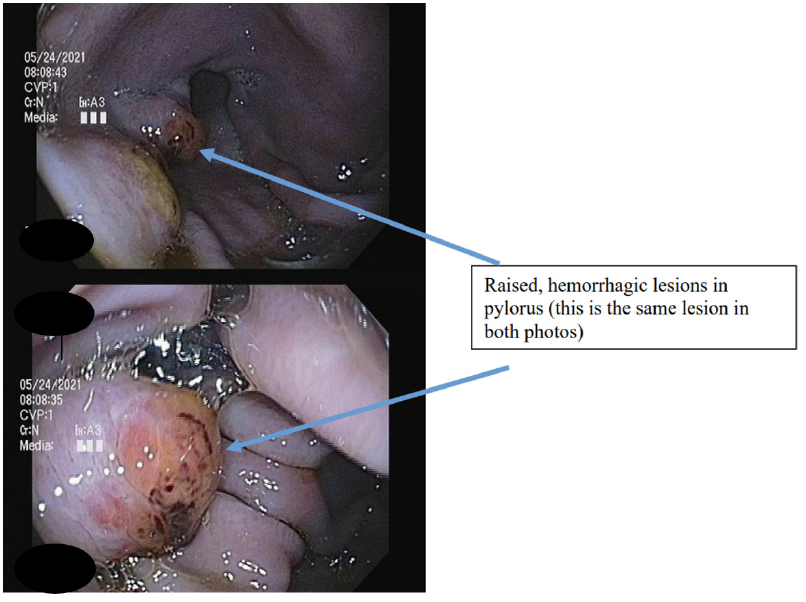 gastroscopy image of horse with gastric ulcers