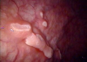 endometrial cups mare