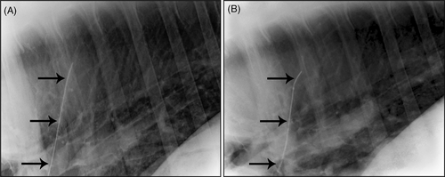 Thoracic radiographs of a 6-year-old Standardbred mare. The guidewire (black arrows) was located within the left pulmonary artery. 
