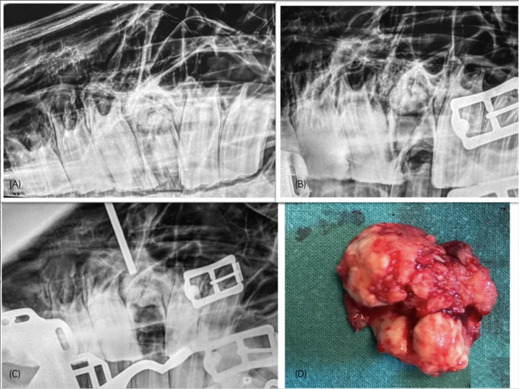 (A) Radiograph taken prior to attemped oral extraction, showing a grossly demineralized (radiolucent) 209, with radio dense apical hypercementosis and chronic midline sagittal fracture. The 208 and 210 have both drifted into the fracture site. (B) After failed oral extraction—the tooth fractured into multiple pieces—with dental material lining the alveolus and still present at the apical area. The apical fragment was firmly attached and could not be loosened with dental picks. (C) An intra-operative radiograph confirming 5 mm pin placement over the apex, prior to repulsion. (D) Apical hypercementosis—after repulsion.