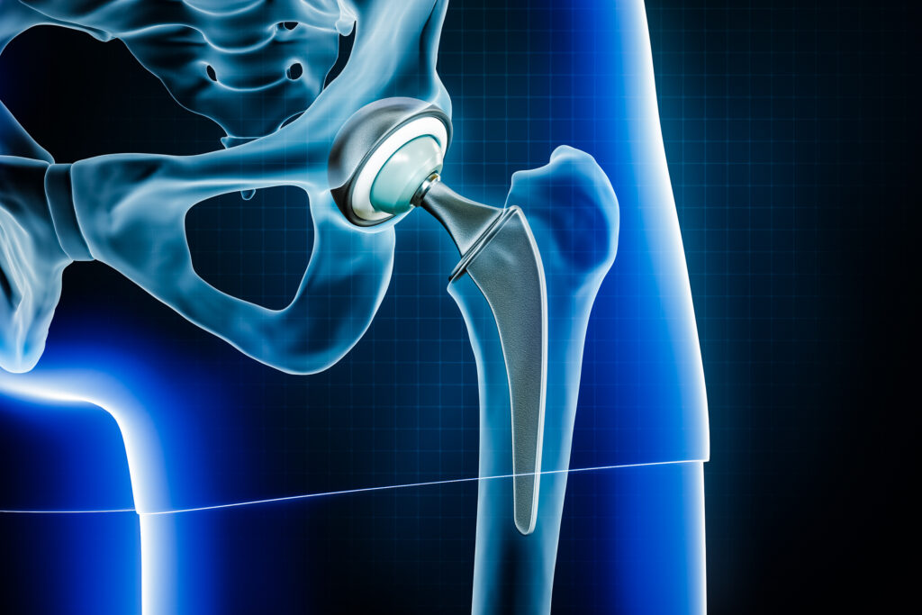 Arthroplasty, hip replacement, joint replacement