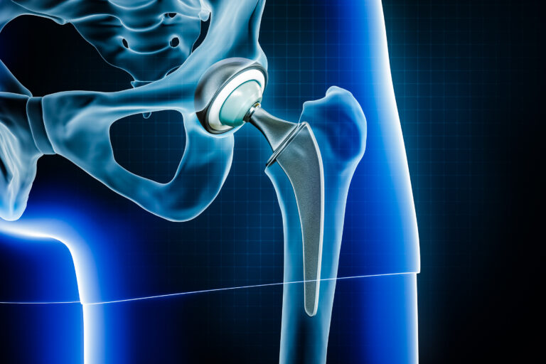 Femoral head hip prosthesis or implant. Total hip joint replacement surgery or arthroplasty 3D rendering illustration. Medical and healthcare, arthritis, pathology, science, osteology concepts