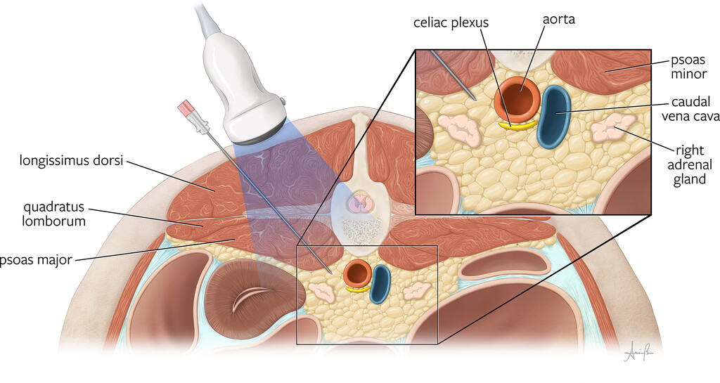 Ultrasound-guided celiac plexus injection technique. Holding the probe in transverse orientation between L1 and L2, the needle is advanced in a dorsolateral/ventromedial direction through the longissimus dorsi, psoas major, and psoas minor muscles, aiming to deposit the solution ventrally to the psoas muscle, as close as possible to the aorta. Illustration by Allison Buck, MFA, CMI, Medical Illustrator, Educational Support Services, Cornell University College of Veterinary Medicine.