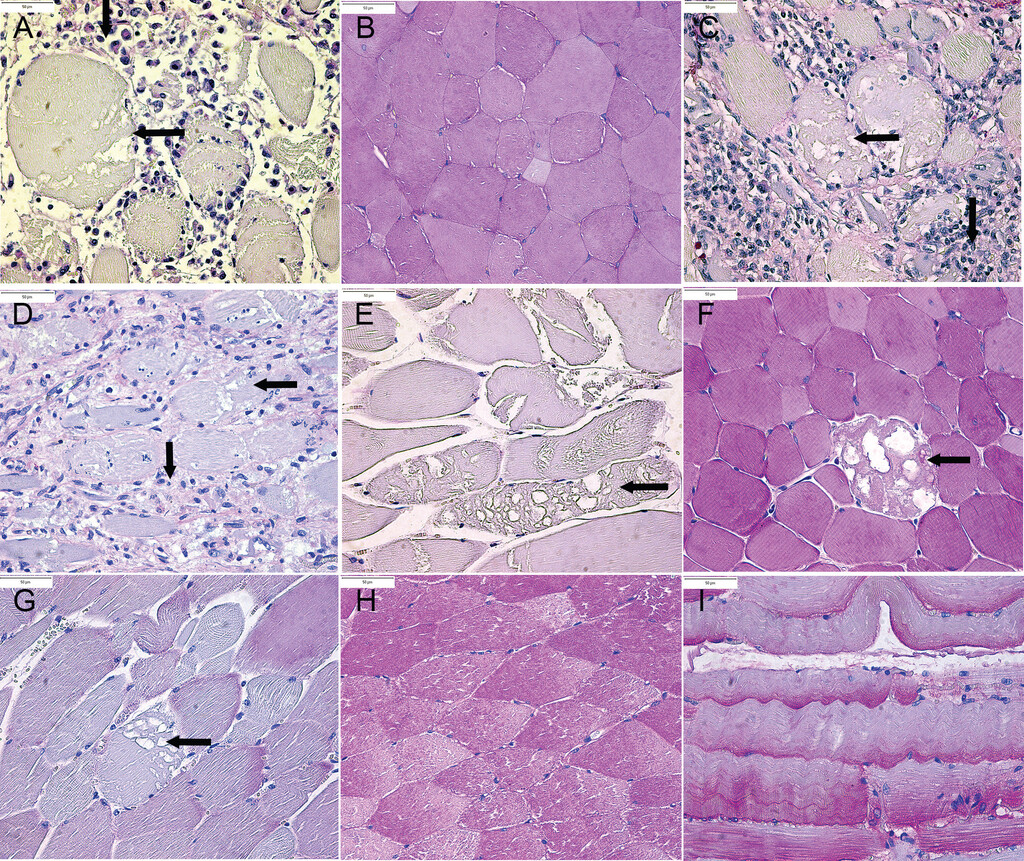Skeletal muscles from horses 1 through 7 and control sections stained with periodic acid–Schiff stain for glycogen. Horizontal arrows indicate acute necrosis, and vertical arrows indicate chronic myodegeneration. 